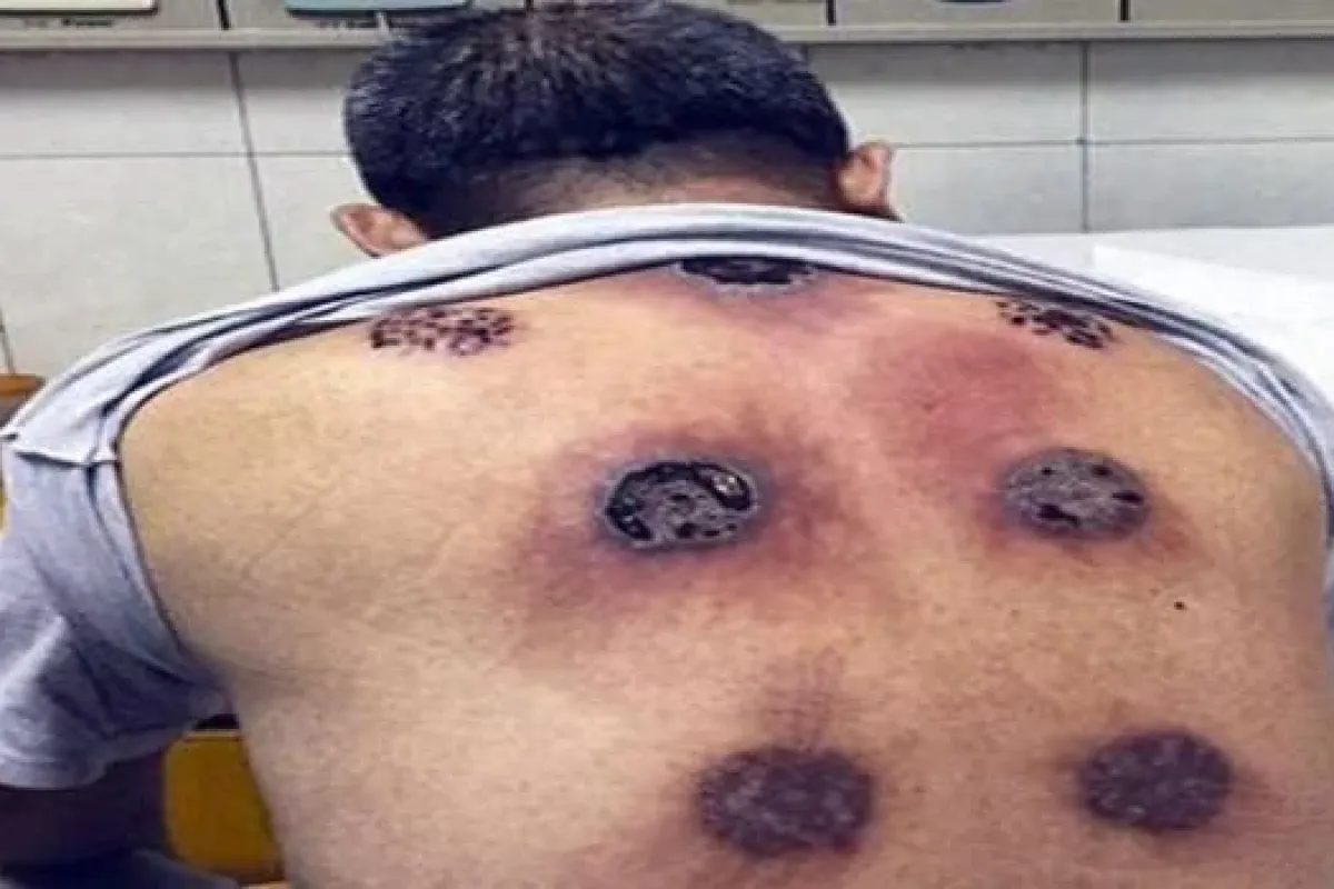 Bardak çektirdi, sırtı yandı