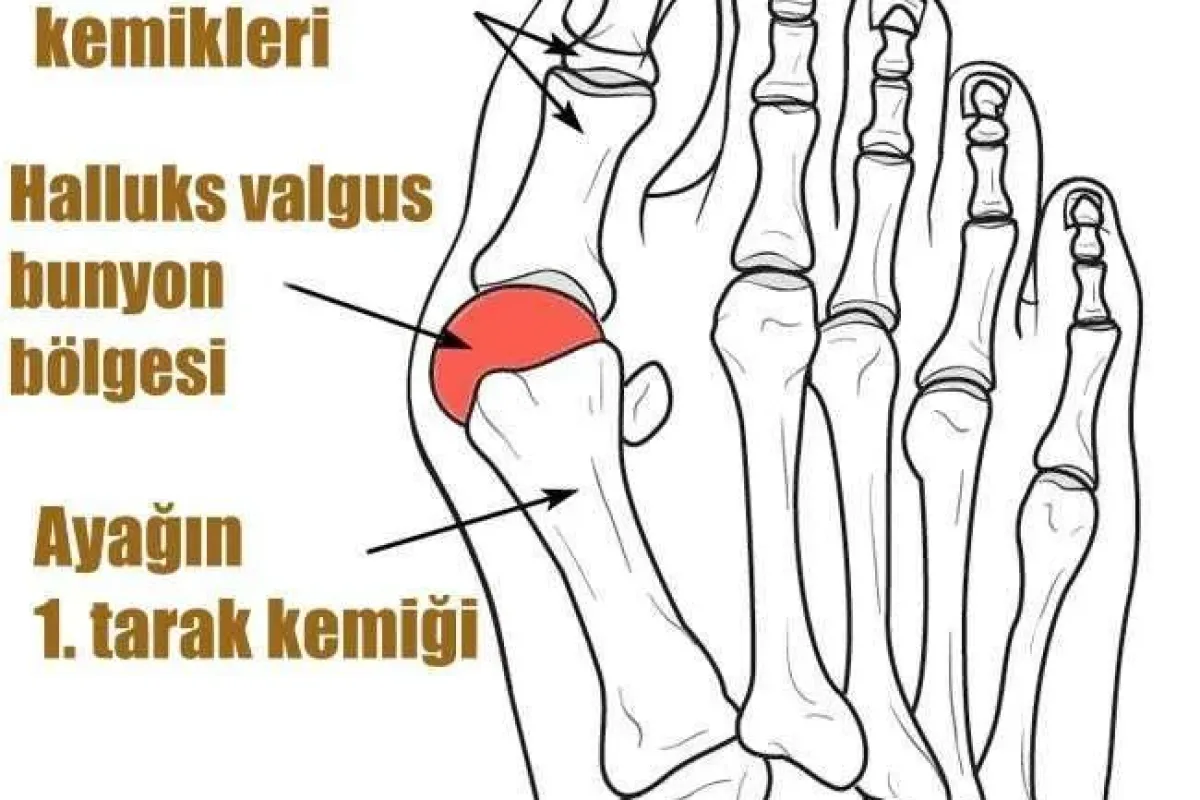 Dar ve sivri burunlu ayakkabılar şekil bozukluğuna sebep oluyor