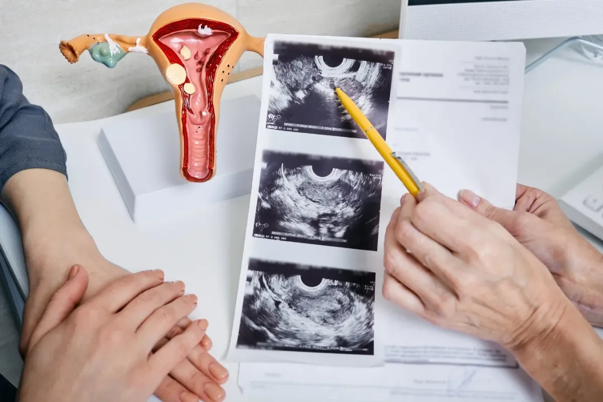 Polikistik Over Sendromu (PKOS) Nedir, Nasıl Tedavi Edilir? Belirtiler ve Risk Faktörleri