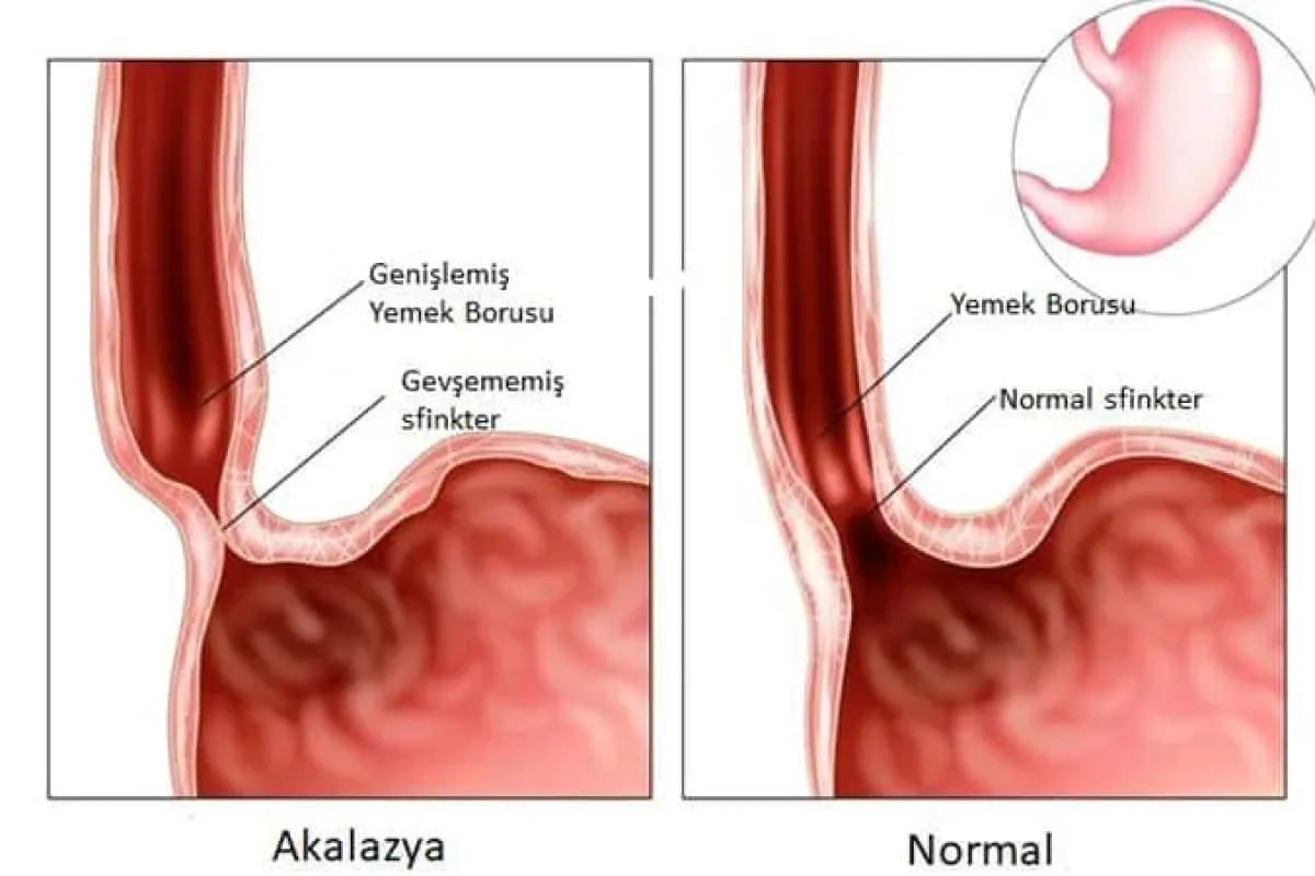 Akalazya Yutma Güçlüğü Artık Ciddiye Alınmalı!