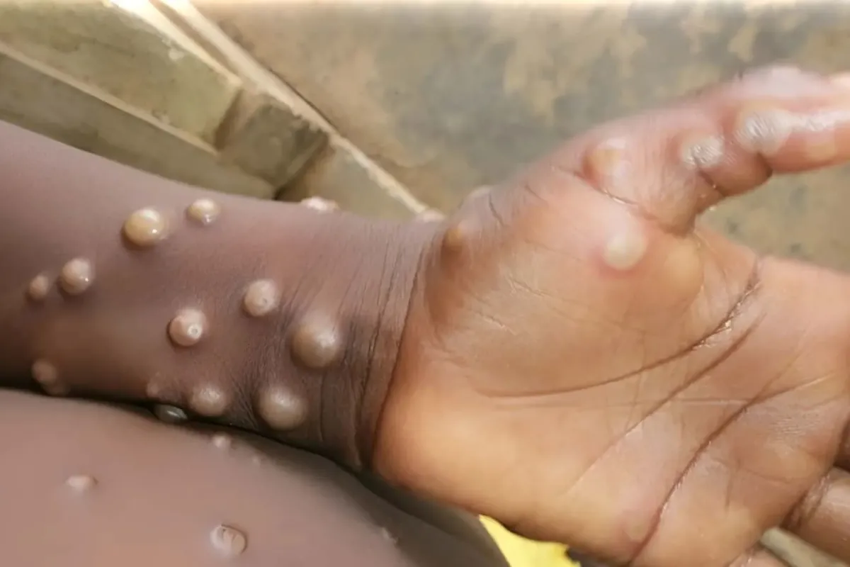 Ölümcül Mpox’un En Tehlikeli Semptomu Ortaya Çıktı!