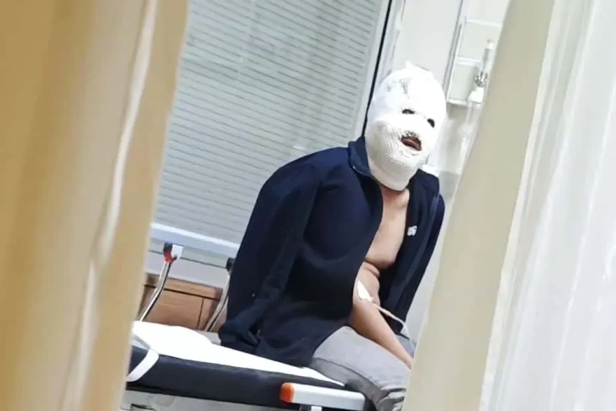 İnegöl'de Sobayı Yakarken Yüzünü Yaktı