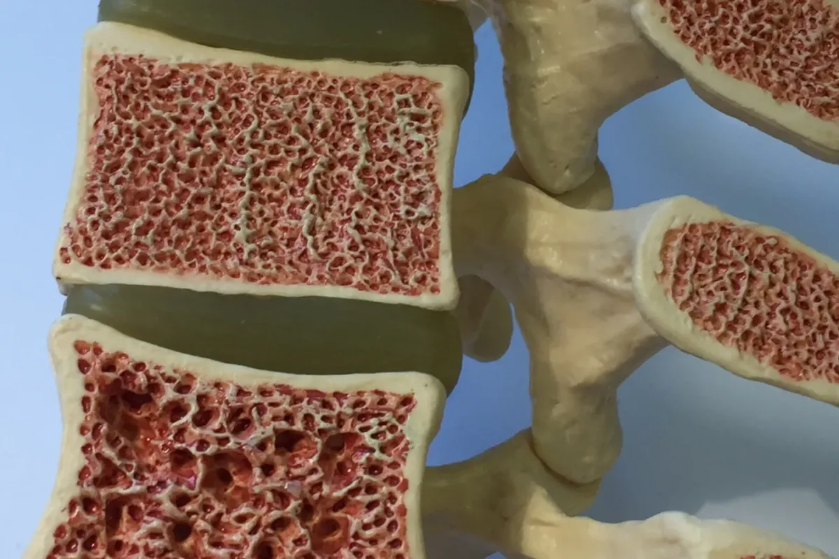 Kemik Erimesi Nedir? Belirtileri ve Tedavi Yöntemleri