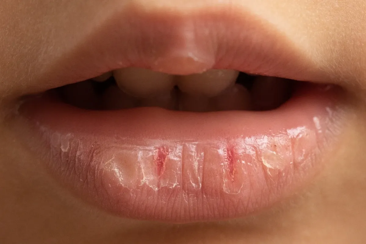 Dudak Çatlaklarına Karşı Doğal Çözümler