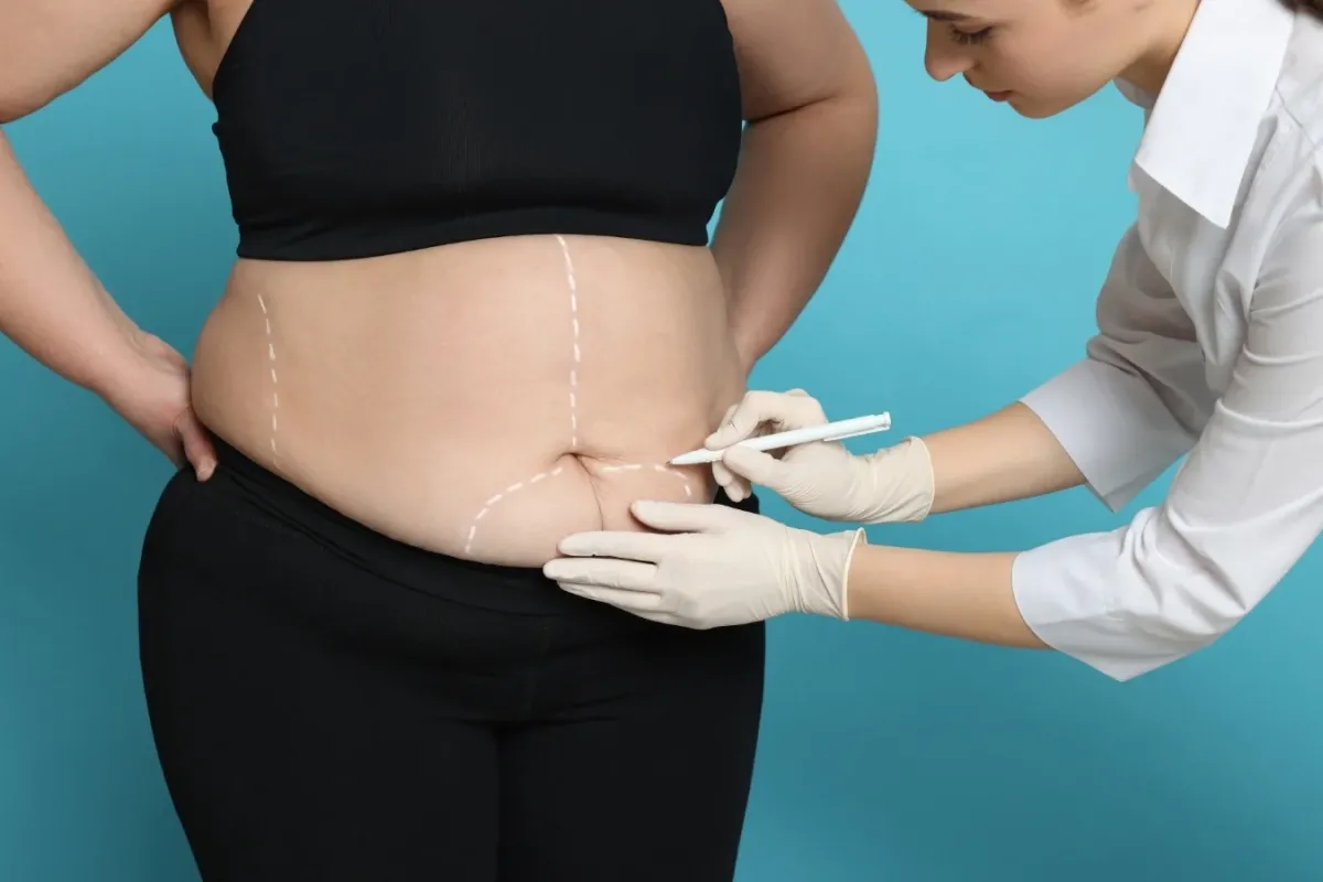 Liposuction Nedir? Bölgesel Yağlanmaya Kalıcı Çözüm mü?