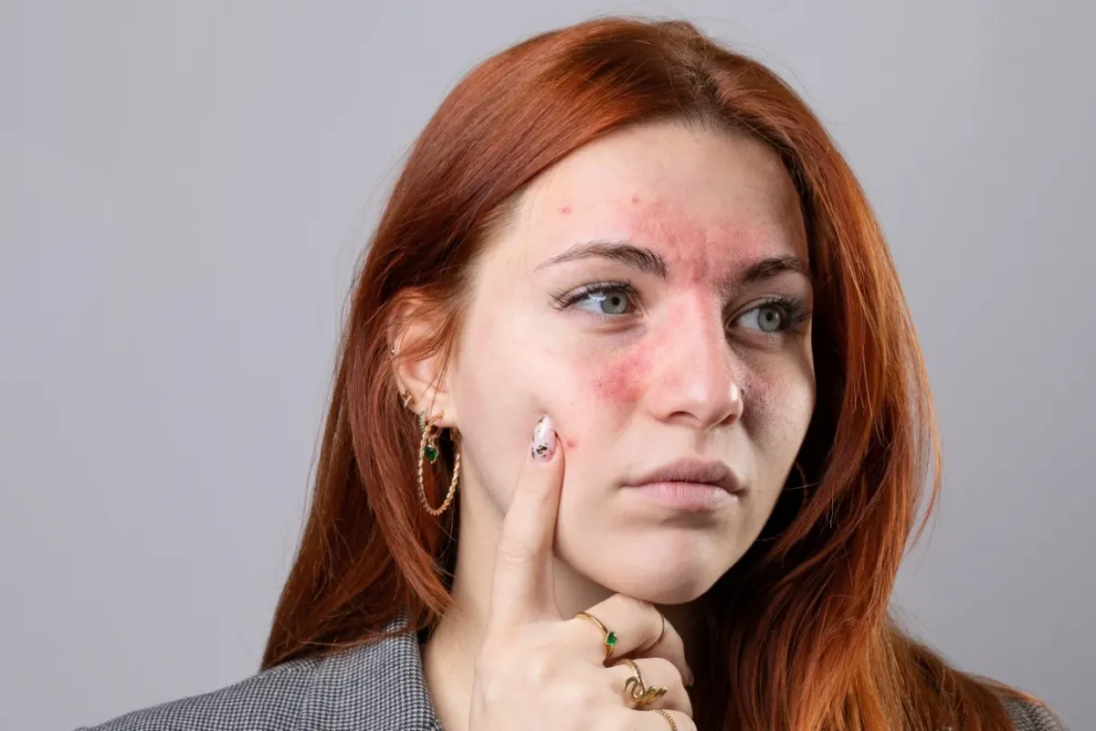 Egzama Neden Olur, Nasıl Tedavi Edilir?
