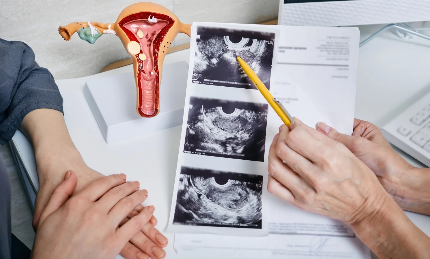 Polikistik Over Sendromu (PKOS) Nedir, Nasıl Tedavi Edilir? Belirtiler ve Risk Faktörleri