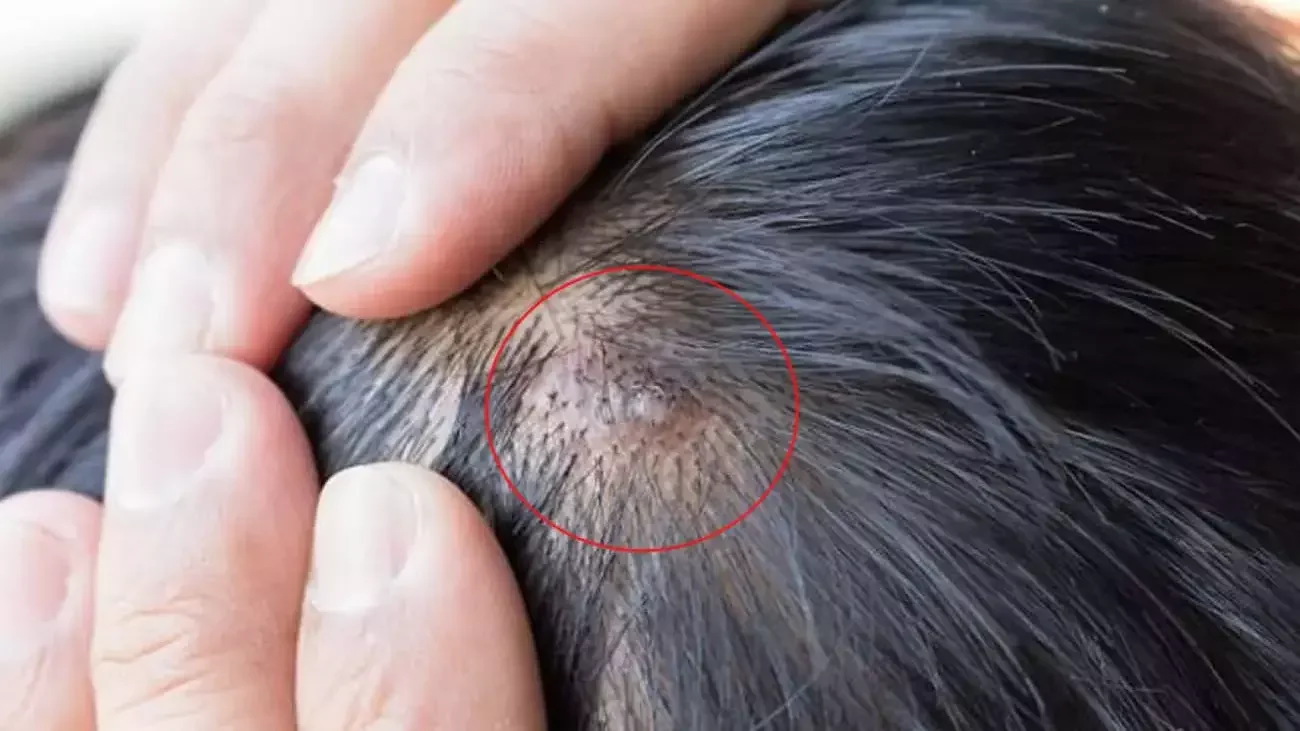 Kafada sivilce neden çıkar, nasıl geçer ve önlenir?